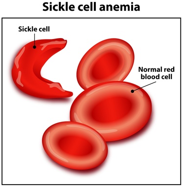 Possible Cure for Sickle Cell Found in Paris