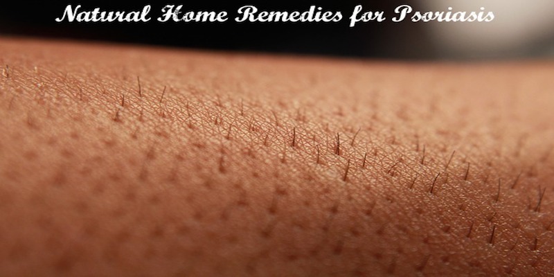 Natural Home Remedies for Psoriasis