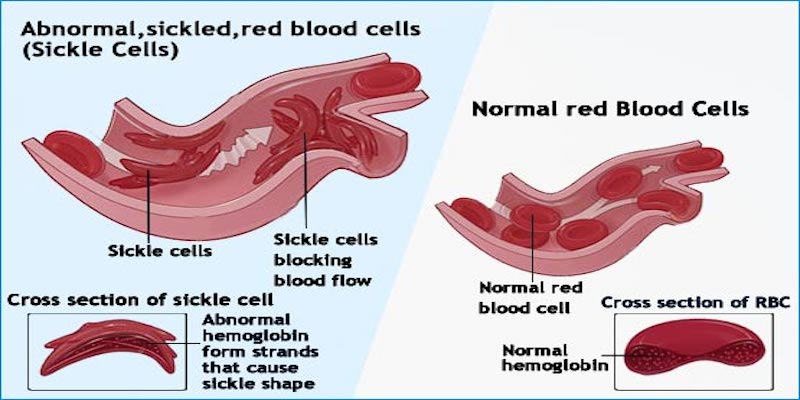 Sickle Cell and Ileus #health #sicklecell #paincrisis