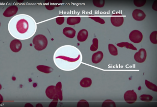 Sickle cell and St. Jude